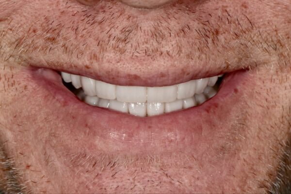 After image of cosmetic dentistry