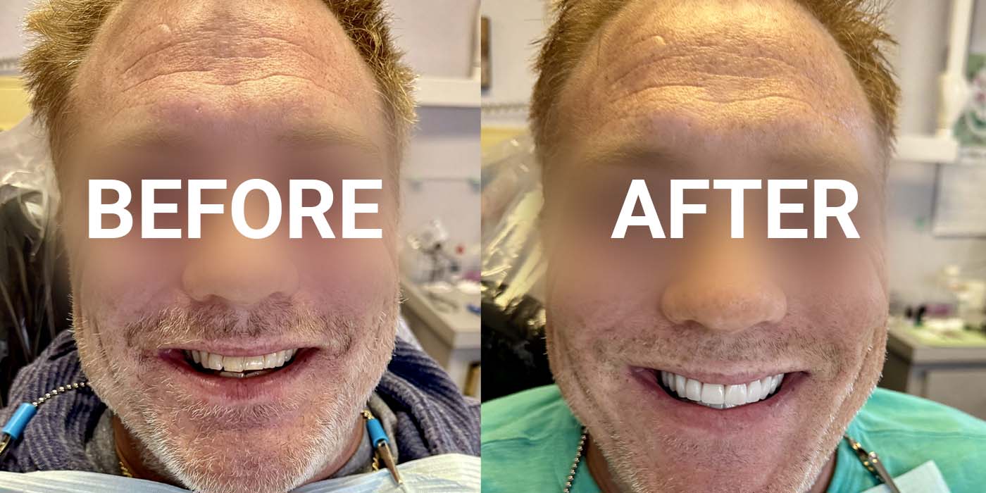 Before and After of cosmetic dentistry on patient