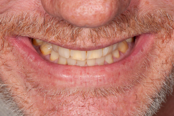 Before image of cosmetic dentistry